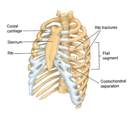 flail-chest-1 | First Aid Courses Nelspruit